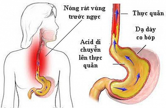 Những bất lợi có thể gặp khi dùng thuốc điều trị trào ngược dạ dày thực quản
